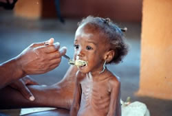 Afrique - Somalie - Famine - Enfant